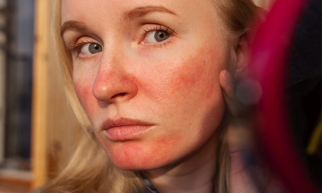 Researchers explain what's really causing the redness on your face