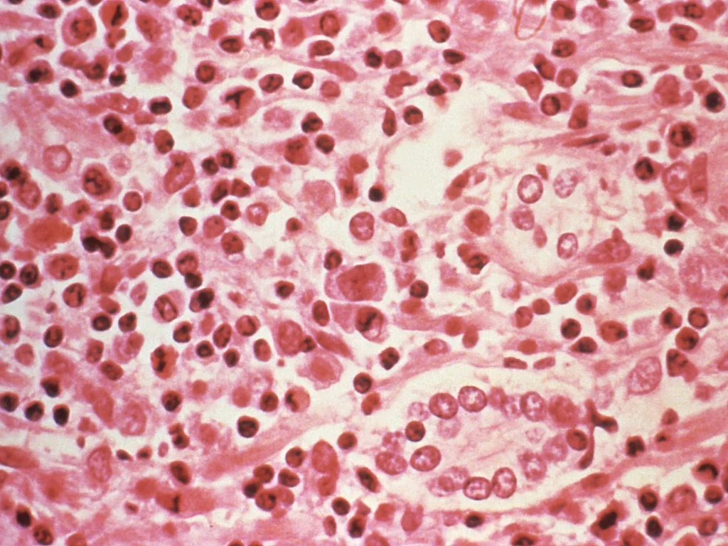 Three dead in suspected hantavirus outbreak on Atlantic cruise ship health News